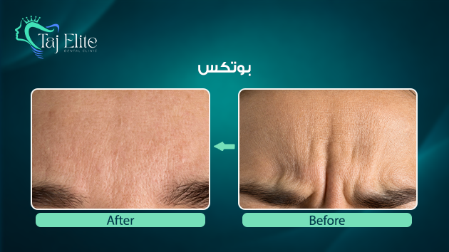 before-^-after19